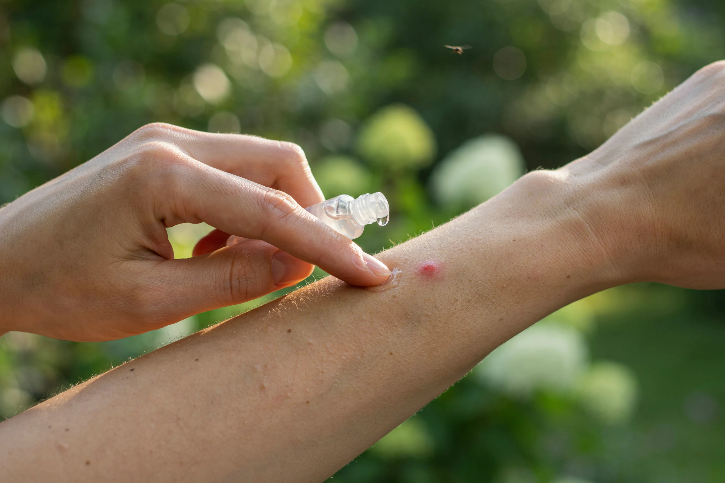 Top Mosquito Bite Relief Tips